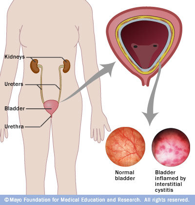 interstitialcystitis-1.jpg