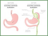 gastric-bypass-surgery.jpg