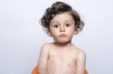 child-with-measles.jpg child-with-measles.jpg